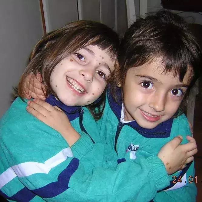 全身黑斑被骂“斑点狗”，身高160的她却成为最美超模…