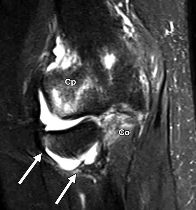 骨折处出现麻痹感,骨折跟精神状态有关