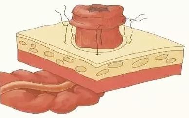 造口患者的心理,造口人真的存在心理障碍吗