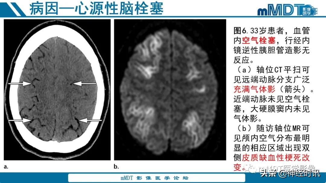 缺血性脑卒中护理课件,缺血性脑卒中讲课ppt