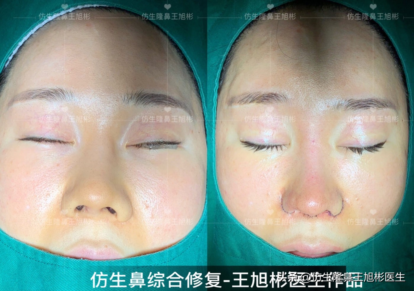 隆鼻的骨粉不取出有什么危害,骨粉隆鼻没有不适需要取出吗