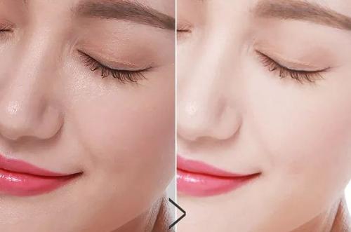 今天治疗,明天上班,激光中的“法拉利”超皮秒