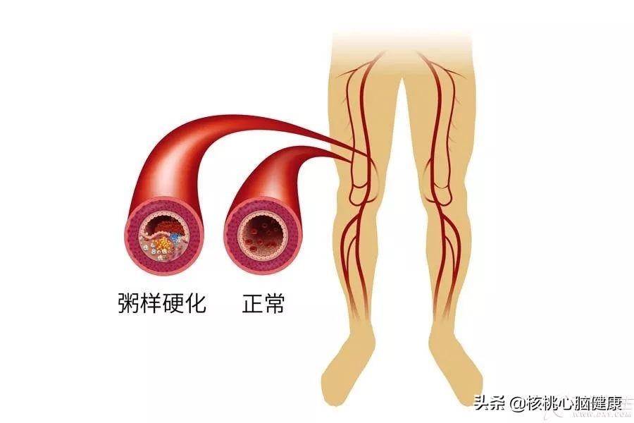 引起下肢动脉硬化原因是什么,下肢动脉硬化疼痛如何缓解