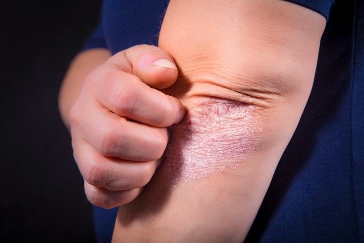 让650万人为之困扰的银屑病,世界银屑病患者人数