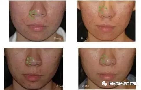 脸部皮肤严重缺水怎么调理,皮肤油光暗沉怎么办