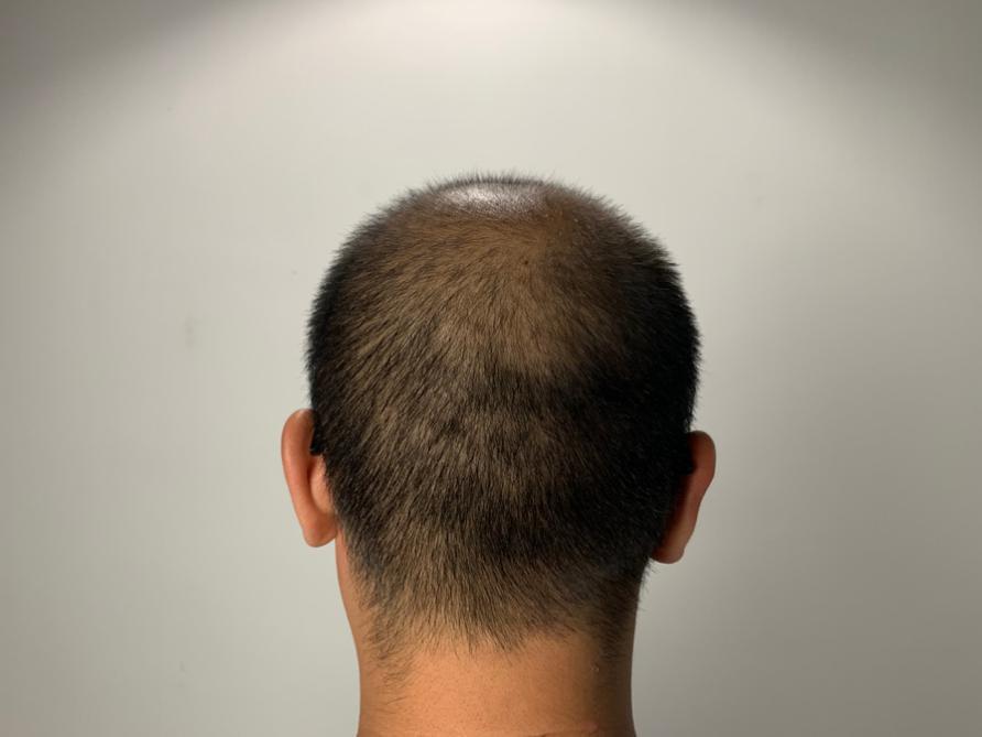 怎样才能不脱发掉发,脱发头发越来越细