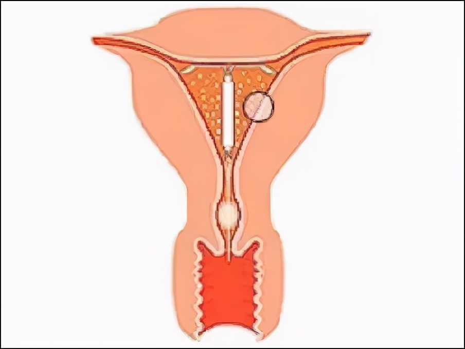 宫内节育器一般使用年限,节育器的种类及放置时间