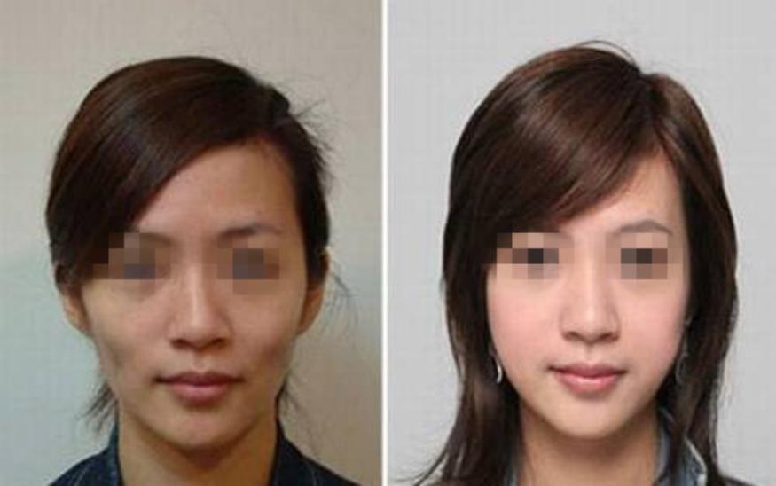 自体脂肪填充的5个坑一定要避开,自体脂肪填充一次能达到效果吗