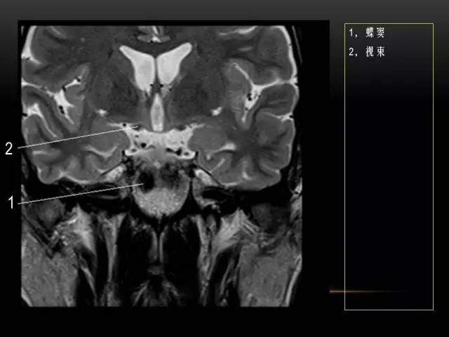 鼻腔鼻窦及颅底ct影像解剖,鼻窦解剖mri