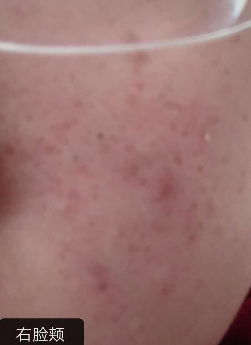 如何有效修复敏感肌,适合油性敏感肌的精华