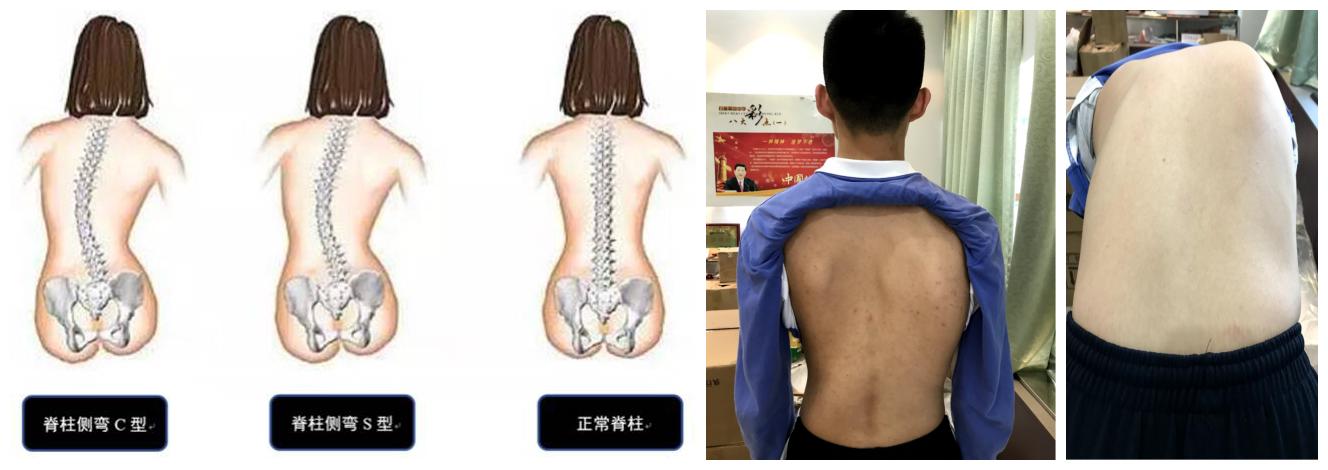 10岁孩子脊柱凸起是什么原因,10岁孩子后背脊柱突出图片