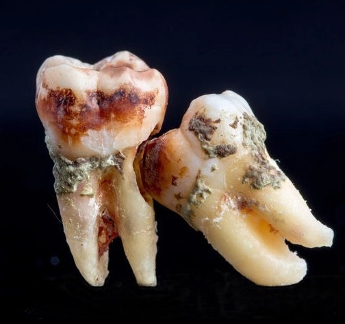 拔智齿会痛吗拔智齿要注意什么,拔智齿会很痛吗