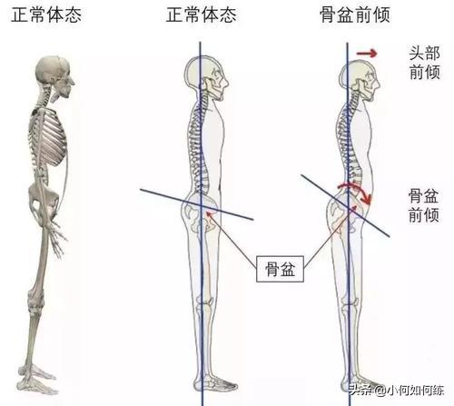 腰竖脊肌酸痛怎么锻炼,久坐竖脊肌疲劳如何缓解