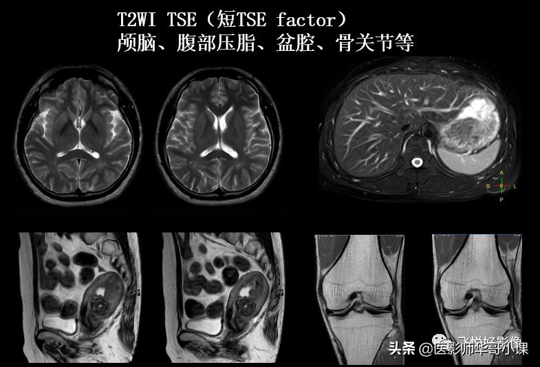 飞利浦磁共振图像操作,飞利浦磁共振成像序列及应用