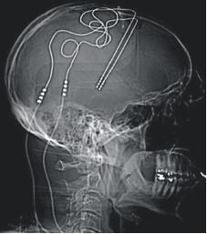 dbs脑深部电刺激术治疗强迫症吗,脑深部电刺激对帕金森效果如何