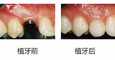 后槽牙缺失不想种植还有什么方法,牙齿缺失的修复方式有哪些