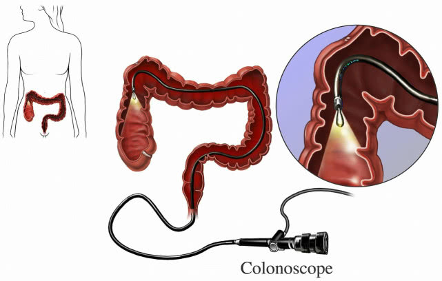 引发肠息肉原因有哪些,肠息肉早期症状有腹痛腹胀现象吗