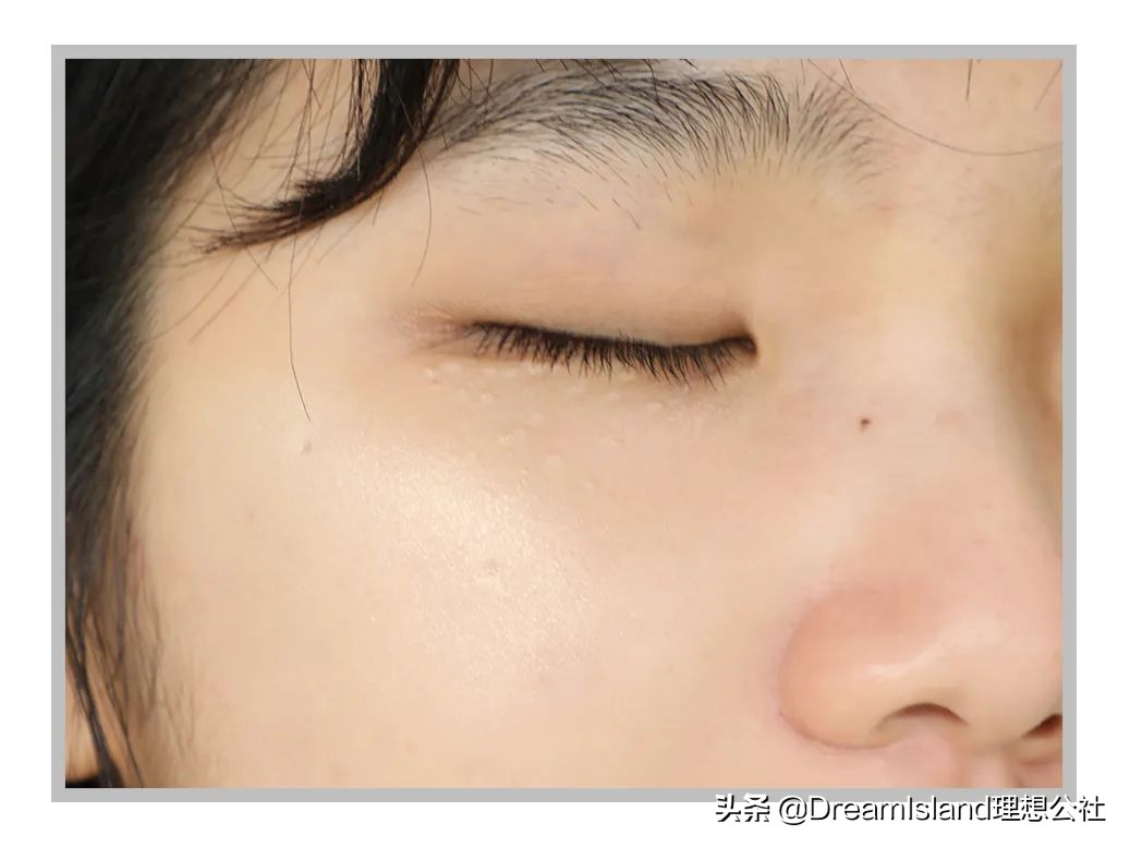 玻尿酸高光排名,打玻尿酸高光推荐