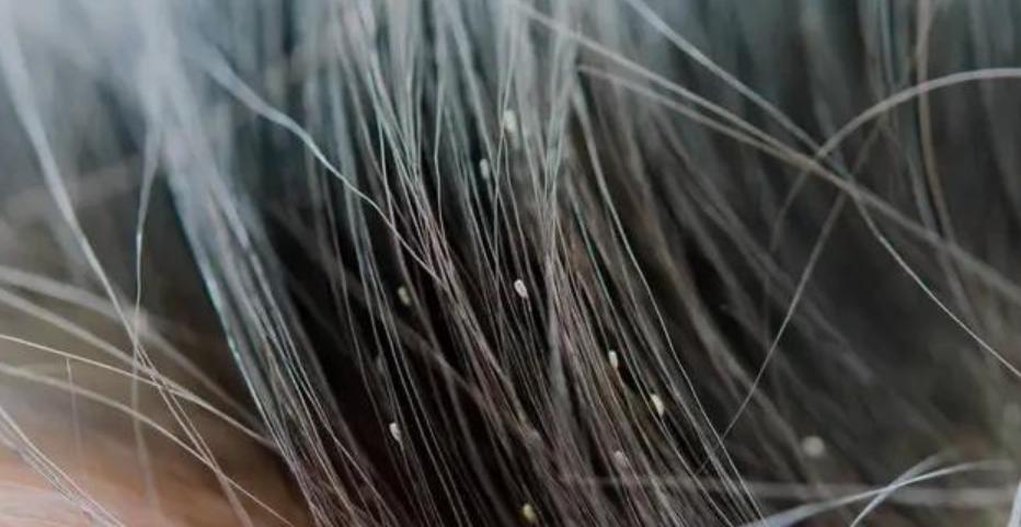 人类进化虱子,虱子与人类共存千万年