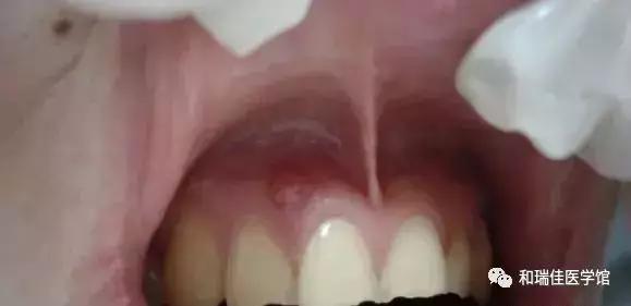 牙龈反复长脓包怎么消除最快方法,根管治疗的牙龈反复长脓包怎么办