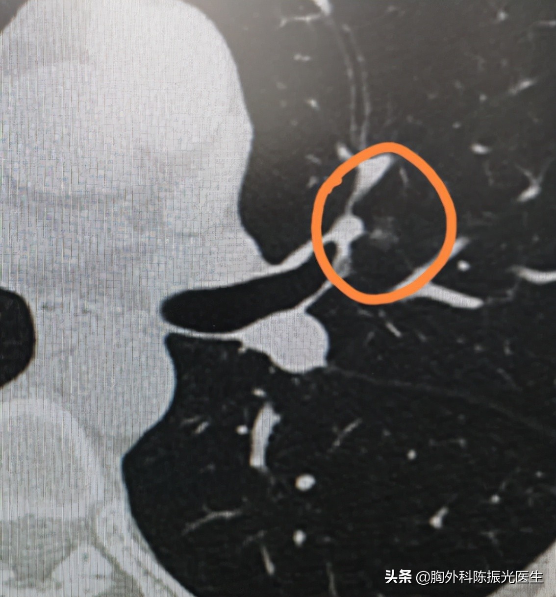 左右两肺背面2枚小结节,右肺上叶尖段1.4厘米是几期肺癌