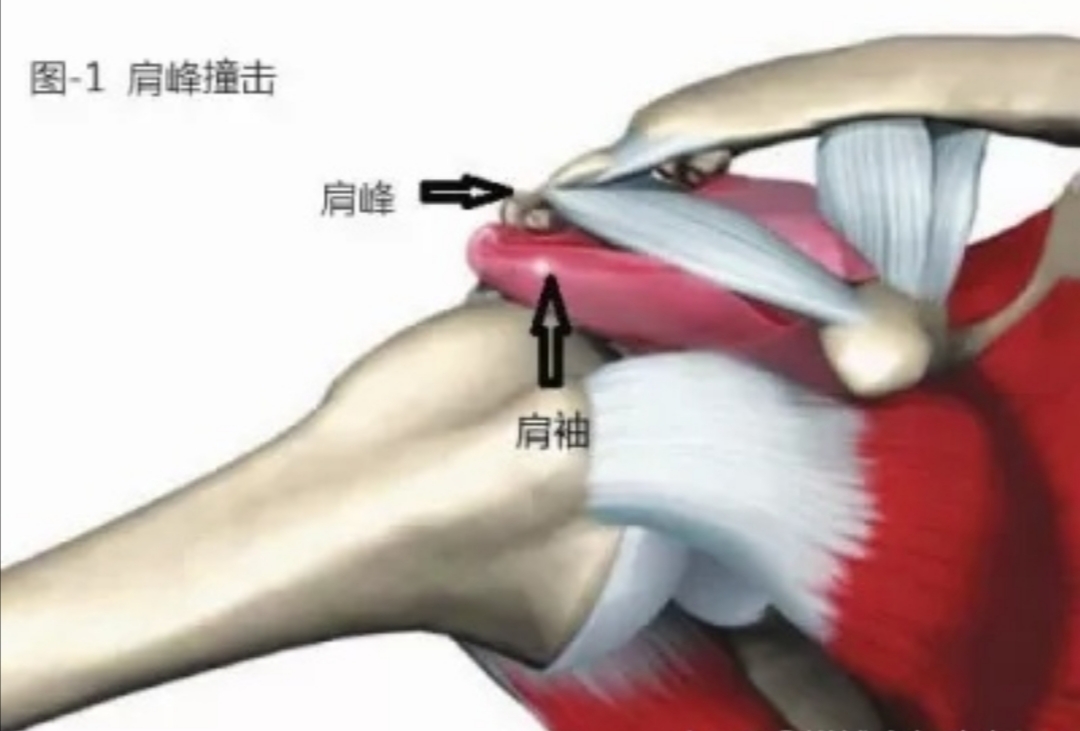 肩峰下撞击会引起什么症状,肩峰撞击导致手臂抬起来疼