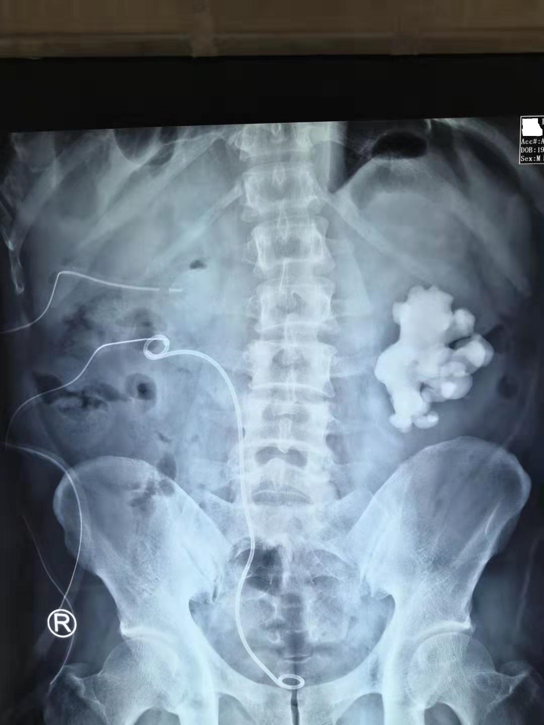 鹿角型结石最严重的后果,疯狂的石头肾脏