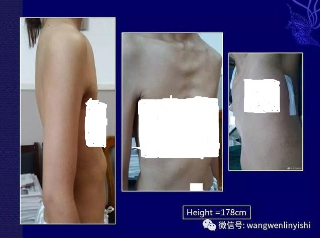 扁平胸合并漏斗胸可以手术矫正吗,扁平胸怎么手术