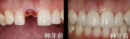 2000块的种植体你真的敢种吗?为什么会这么便宜,良心牙医告诉你