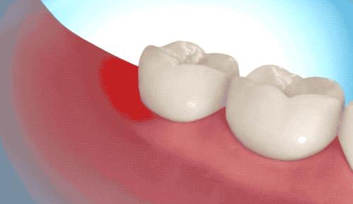 拔智齿是怎么算收费的,拔智齿是按智齿个数收费吗