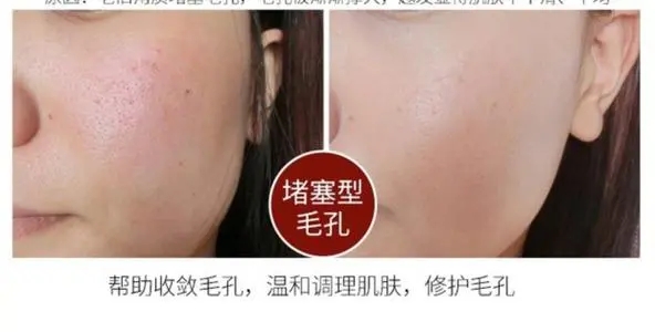 祛痘面霜测评,保湿祛痘面霜推荐哪款