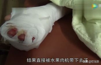 孩子手指被榨汁机绞伤后续,榨汁机伤小孩