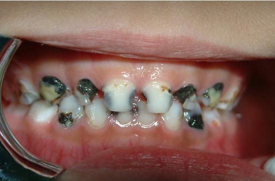 疫情防控期间突然牙痛,疫情之间牙疼我该怎么解决