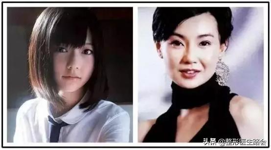 高颧骨苹果肌复位,颧骨太高苹果肌太饱满做什么手术