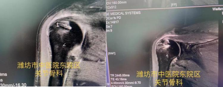 潍坊哪个医院看肩周炎比较好,潍坊中医院颈肩腰腿疼专家