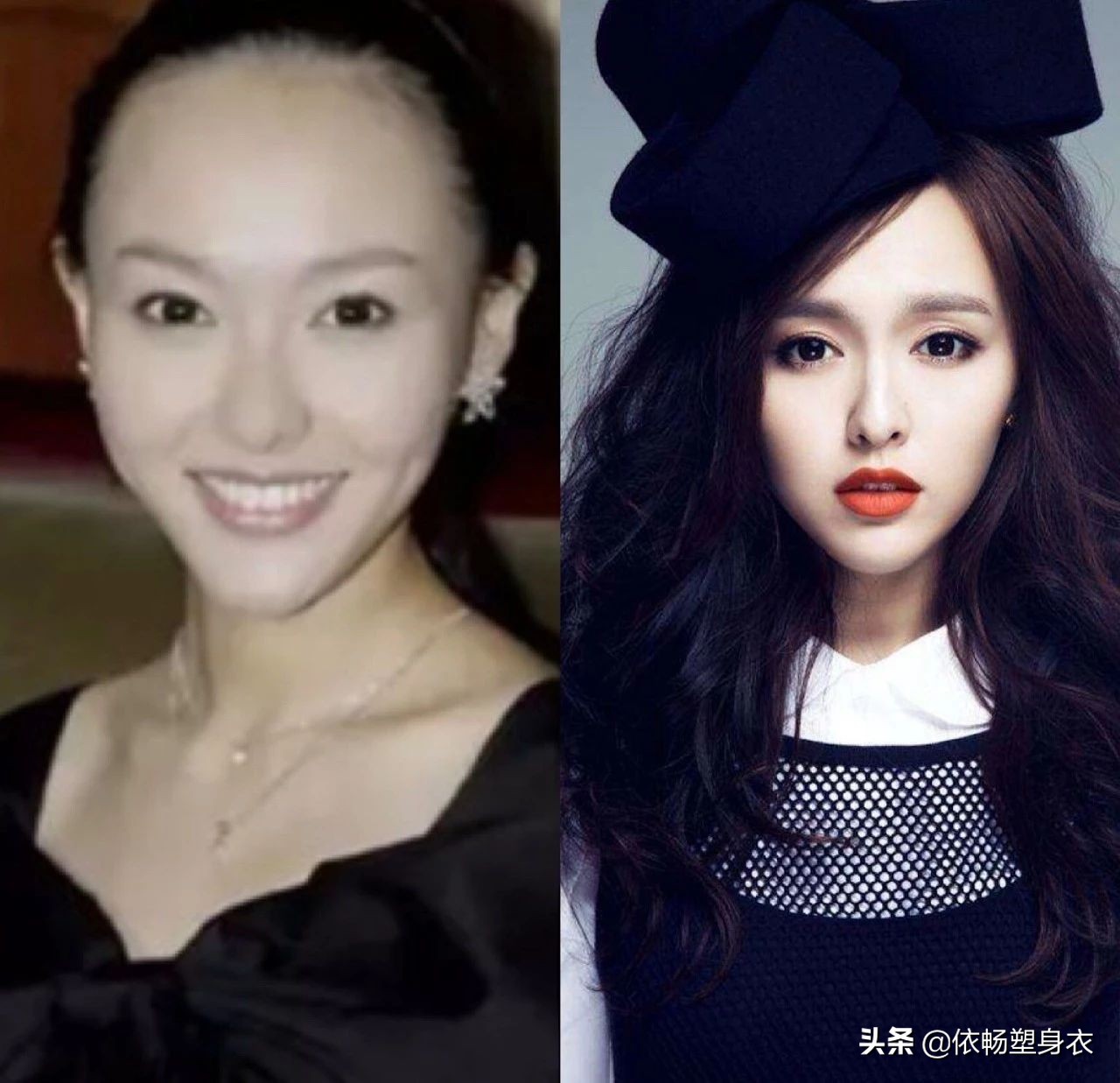 发际线高怎么挽救男生头发,怎么防止发际线后移秃头