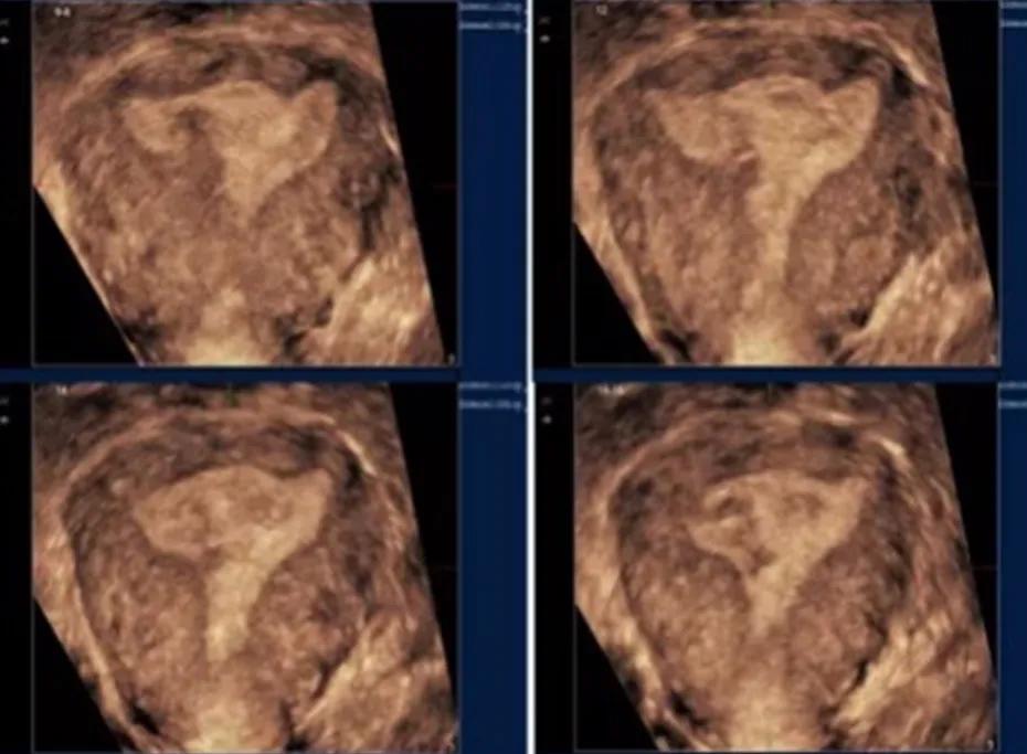 关爱女性｜呵护子宫，不可忽视“宫腔粘连”