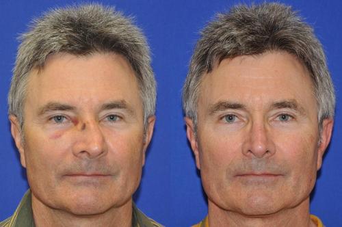 鼻子打架被打歪了治疗需要多少钱,鼻子打歪了属于什么伤