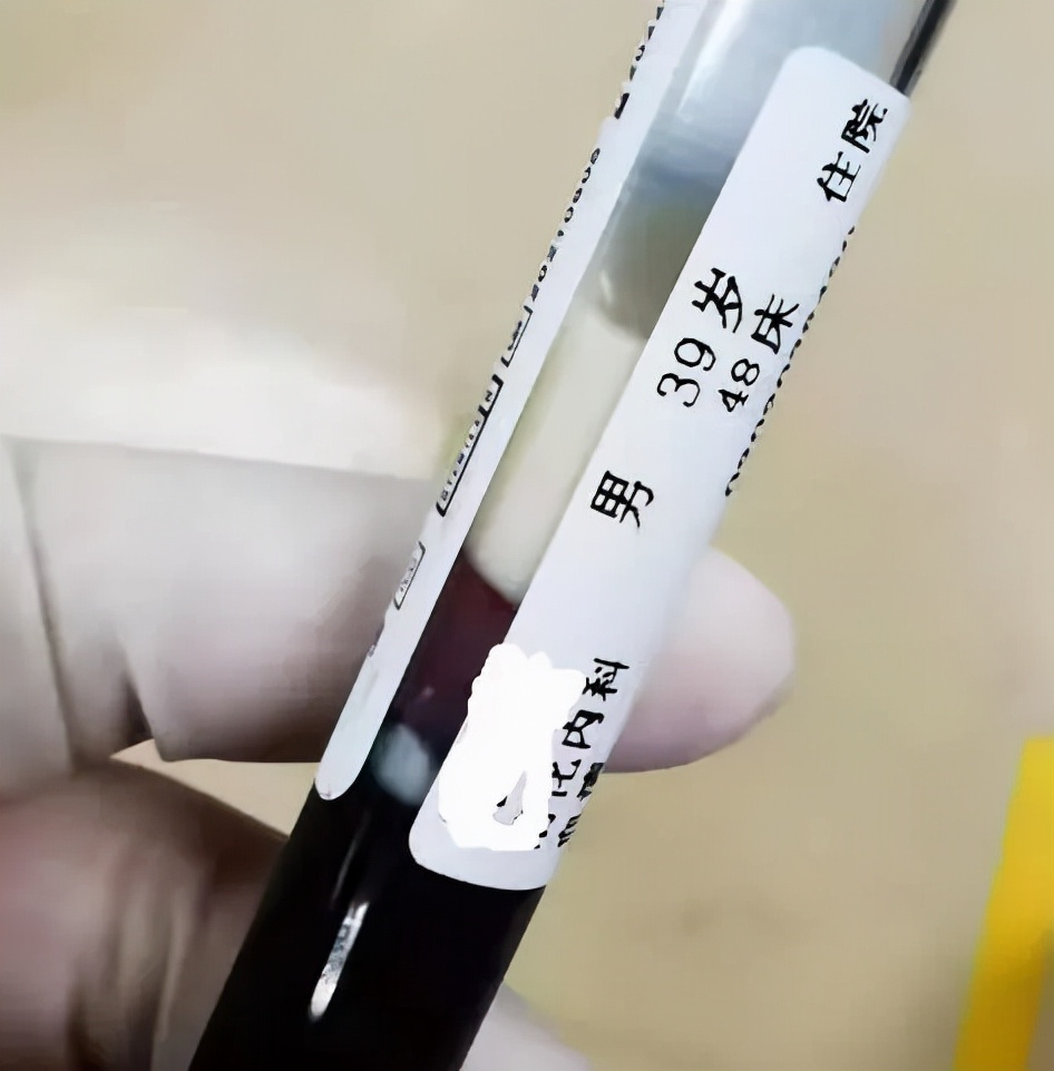 提醒爱喝酒的人：酒后出现6个症状，十有八九是胰腺炎，尽快就医