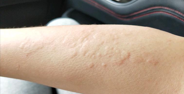 花椒煮水对荨麻疹有疗效吗,苎麻煮水喝可以治荨麻疹吗