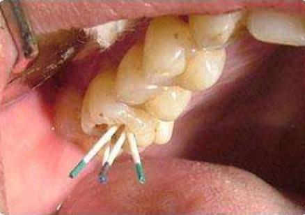 为什么根管治疗后牙齿断裂,根管治疗后的牙怎么做牙冠