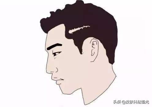 化疗造成的脱发是永久性的脱发吗,梅毒性脱发是一种永久性脱发