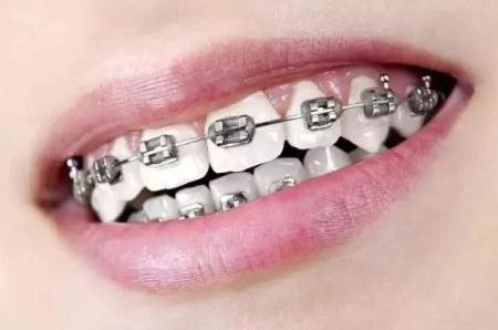 十五岁小孩牙齿矫正注意什么,儿童牙齿矫正后的注意事项
