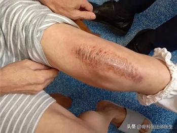 膝关节置换术后伤口渗液,膝关节置换后伤口渗出怎么办