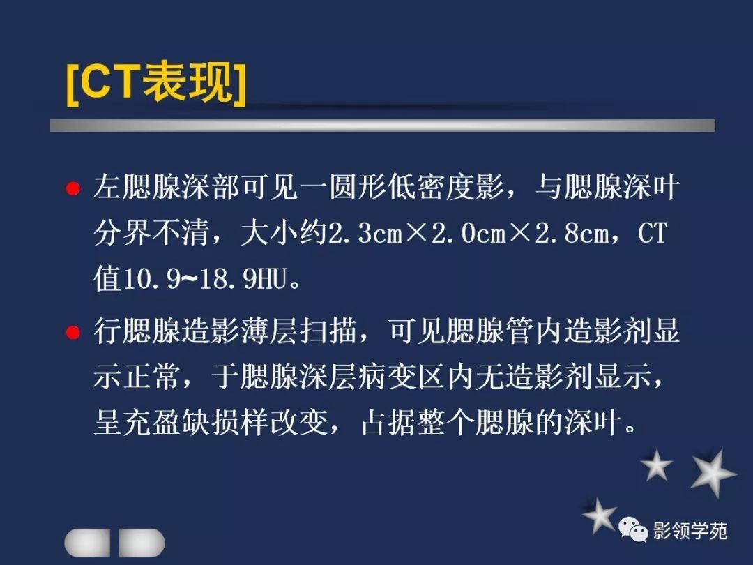 腮腺疾病影像学诊断,腮腺肿块影像诊断