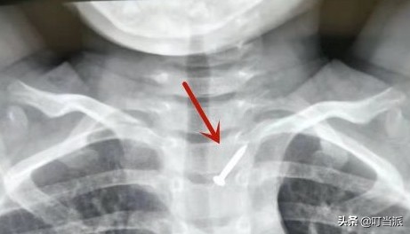 10岁孩子吞了个小钉子能排出吗,2岁宝宝误吞4厘米钉子