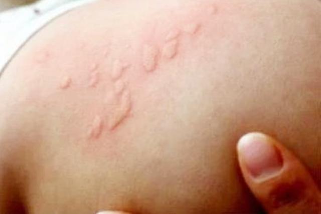婴儿二天身上起疙瘩像蚊子咬一样,两岁宝宝身上起了一片疙瘩还痒