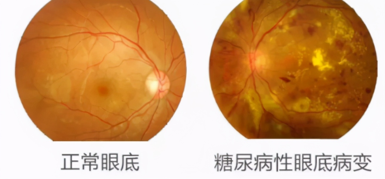 得了糖尿病并发症就一定会出现吗,严重的糖尿病会出现什么并发症