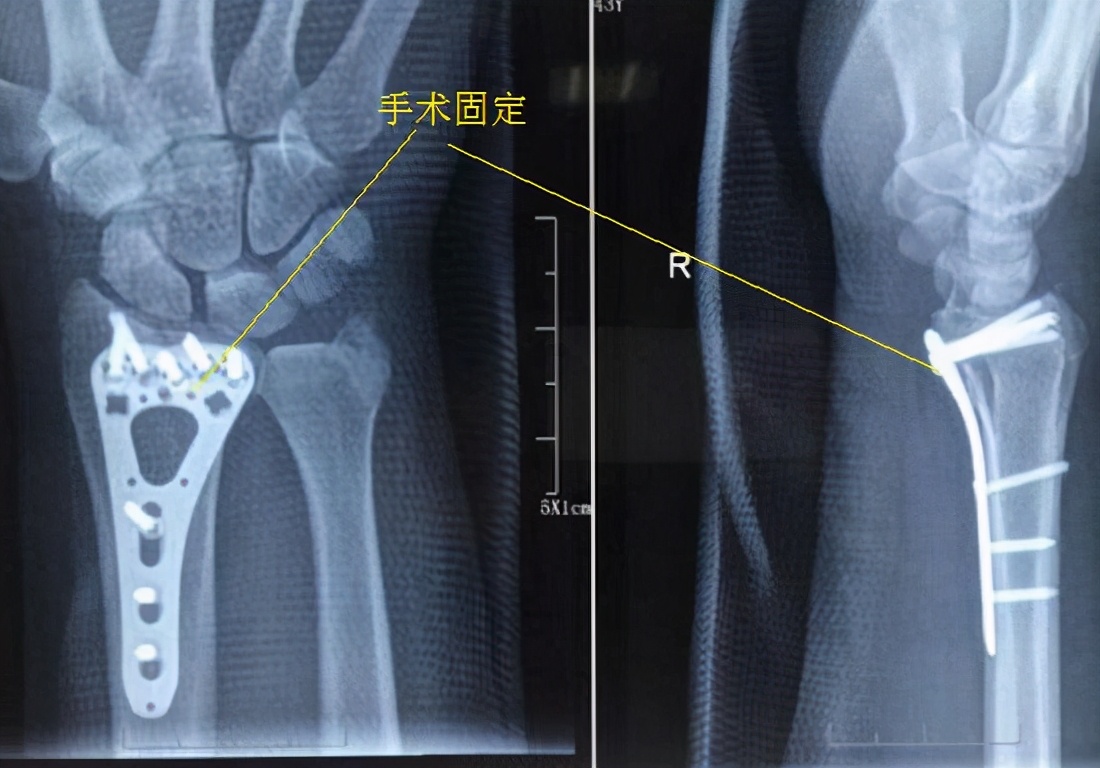 桡骨远端骨折后该怎么做康复,桡骨骨折后康复教程
