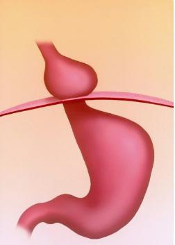 胃食管反流吃了药还是感觉噎,胃食管反流反酸烧心怎么治疗